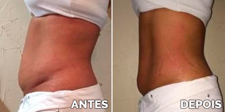 ANTES E DEPOIS 1 1